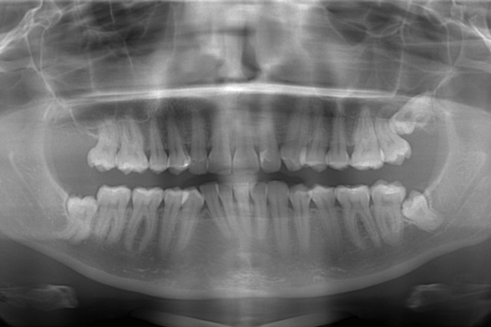 Панорамный снимок моих челюстей с тремя оставшимися зубами мудрости. Они так и не прорезались