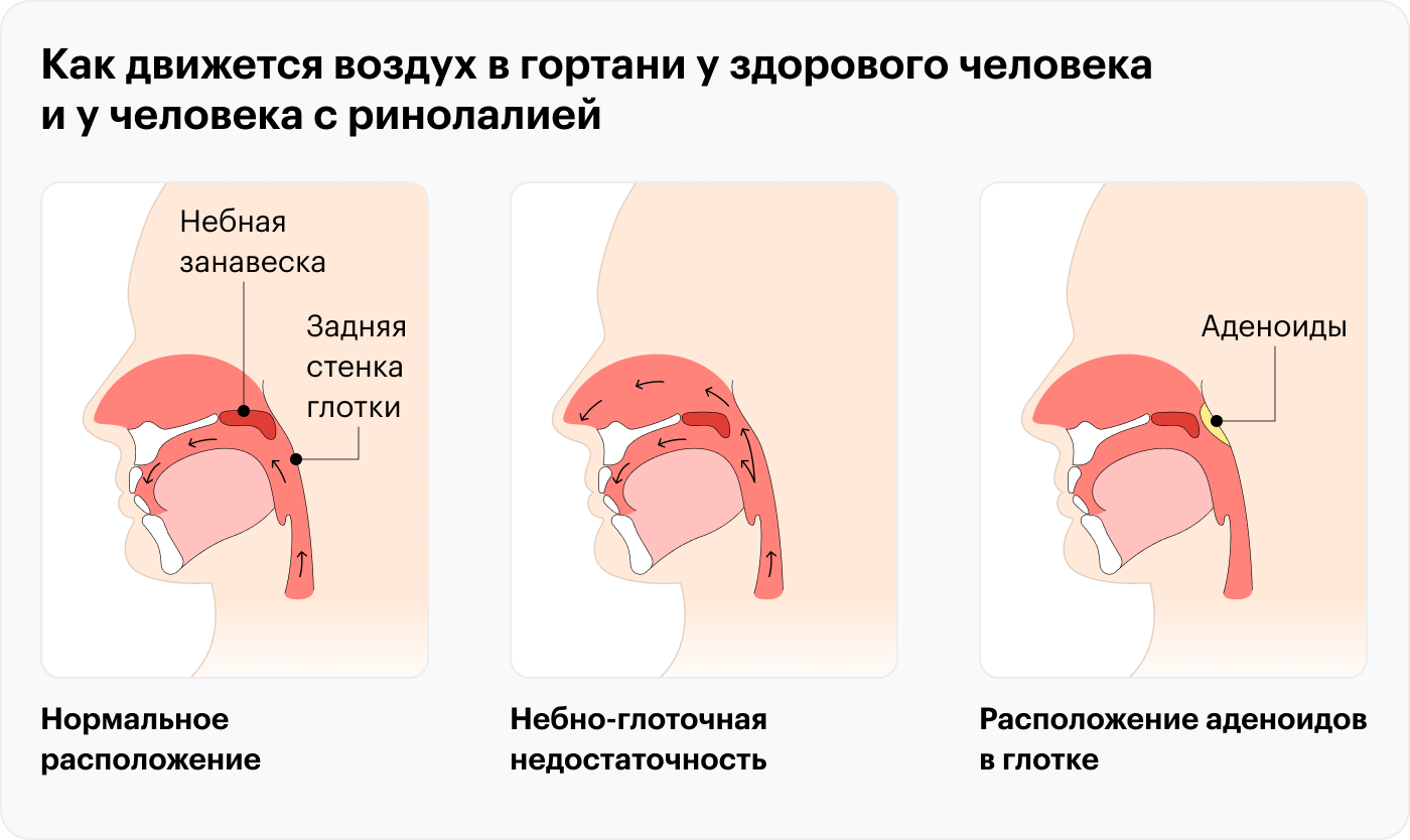 Чтобы произнести большинство звуков речи, воздух и звук нужно направить в рот и перекрыть от попадания в полость носа. Это делает нёбно-глоточной клапан. На рисунке слева показано, как у здорового человека поднимается нёбная занавеска, чтобы сомкнуться с задней стенкой глотки. В центре показана нёбно-глоточная недостаточность, характерная для расщелин нёба. Справа — расположение аденоидов в глотке