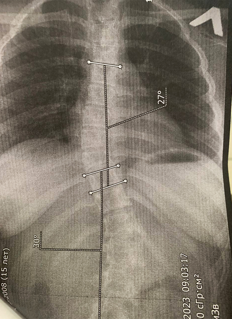 Подросткам со сколиозом нужно регулярно делать рентген, чтобы отслеживать динамику. Так на снимках выглядит прогресс Дарины за год: искривление уменьшилось, но не так значительно, как хотелось бы