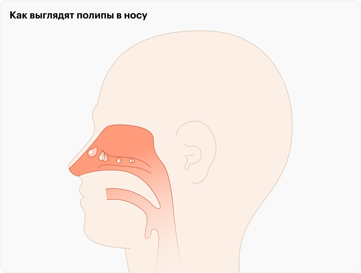 Полипы в носу часто встречаются группами, что немного напоминает виноградную гроздь. Такая преграда может полностью лишить обоняния