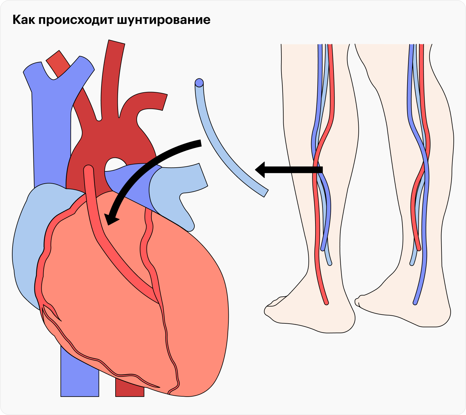 Для шунтирования берут кусочек менее важного сосуда, например вены ноги, и накладывают его так, чтобы кровь шла в обход сужения артерии. Для такой операции нужно сделать разрез в грудной клетке, поэтому сейчас ее используют не так часто