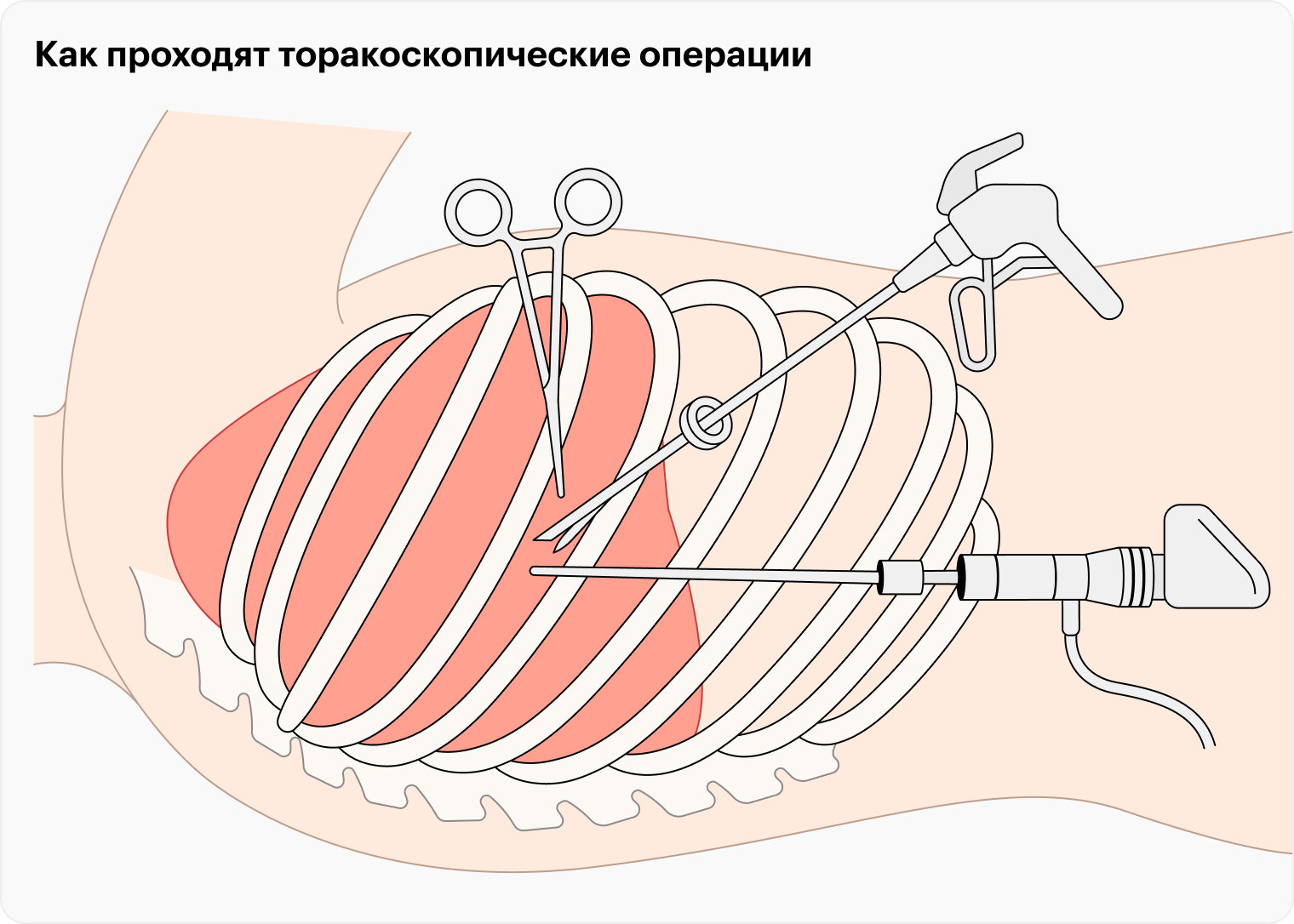 При торакоскопических операциях эндоскоп — специальный прибор с камерой на конце — и хирургические инструменты вводят через небольшие проколы