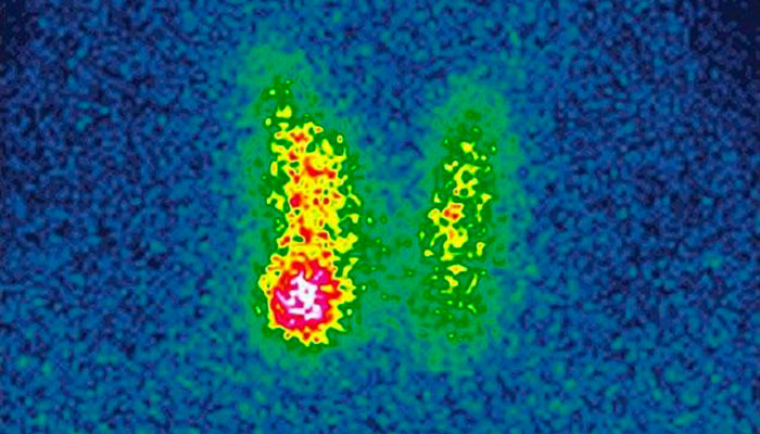 Пример сцинтиграммы. Слева йод остался, а справа клетки железы его захватили и переработали в гормоны. Фото: Институт онкоэндокринологии
