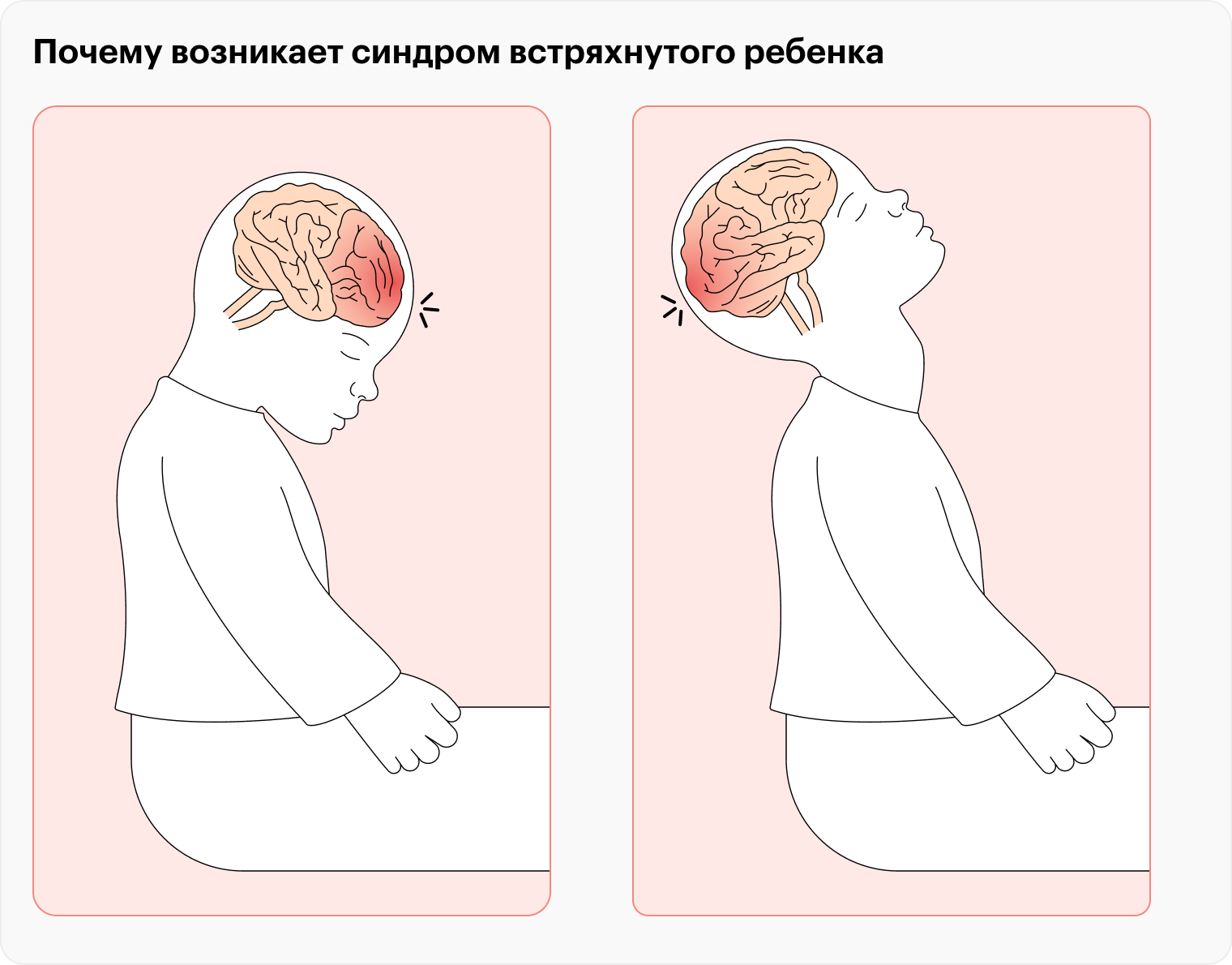 Головной мозг ударяется о переднюю и заднюю стенки черепа, что приводит к повреждению вещества мозга. При этом внешние признаки травмы вроде синяков на теле или лице могут отсутствовать