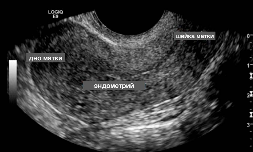 Изображение при трансвагинальном УЗИ. Источник: учебное пособие для гинекологов
