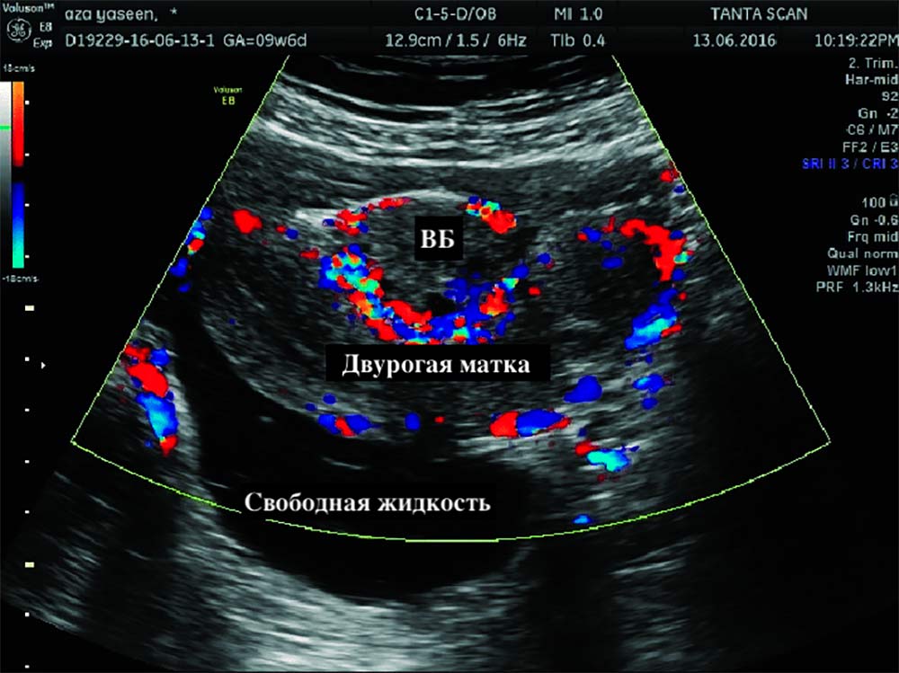 Снимок УЗИ с ЦДК. Обычная картинка УЗИ серая, а с помощью ЦДК получают цветное изображение. Цвета условные — они нужны, чтобы увидеть направление потока крови. В этом случае УЗИ с ЦДК понадобилось для анализа редкого случая — внематочной беременности (ВБ) у пациентки с двурогой маткой. Источник: ResearchGate