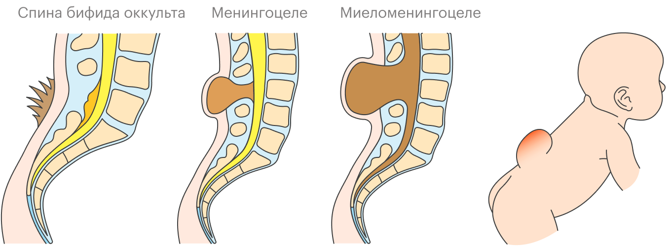 Так выглядят три самых распространенных формы спина бифида. Видно, как в зависимости от степени расщепления позвоночника спинной мозг и нервы развиваются внутри или вне тела — на наружной части спины