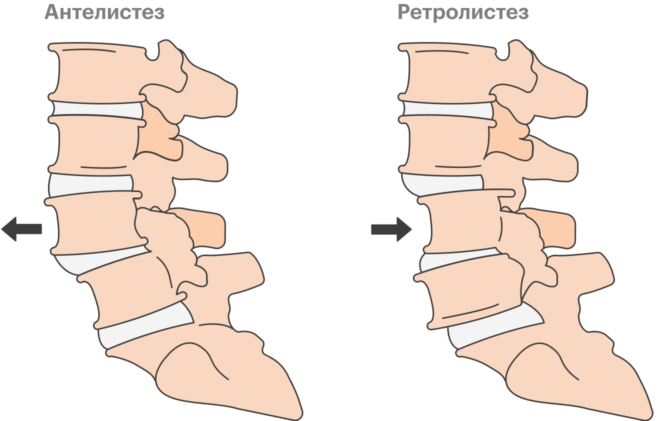 Слева: поясничный позвонок соскользнул в сторону, где расположены тела всех остальных позвонков, — это называется антелистез. Справа: позвонок соскользнул в сторону отростков остальных позвонков — это ретролистез