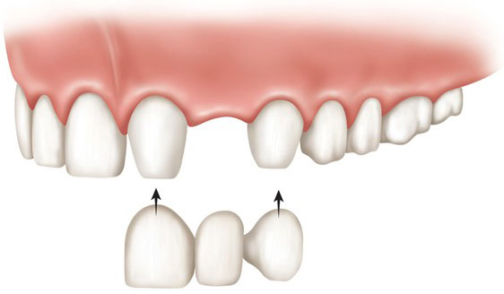 Мост держится на соседних зубах, поэтому дырка в кости для протеза не нужна. Но для моста нужно «обтачивать» соседние, здоровые зубы. Цены на мосты начинаются от 18 000 рублей