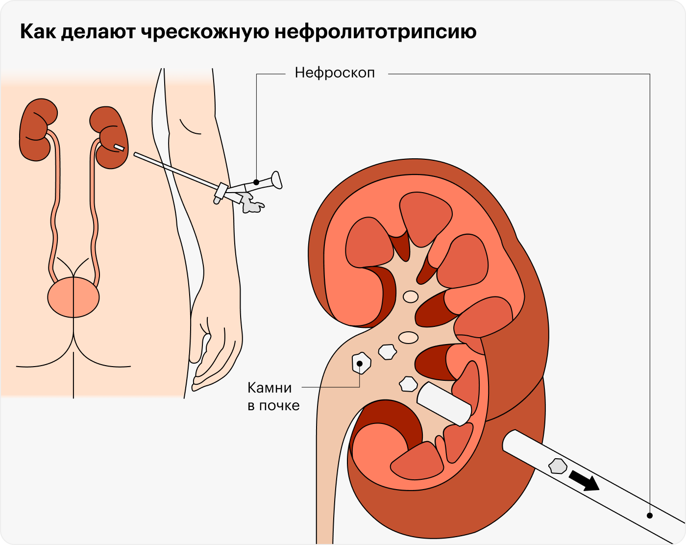 Удаление камня специальным прибором через прокол в коже спины