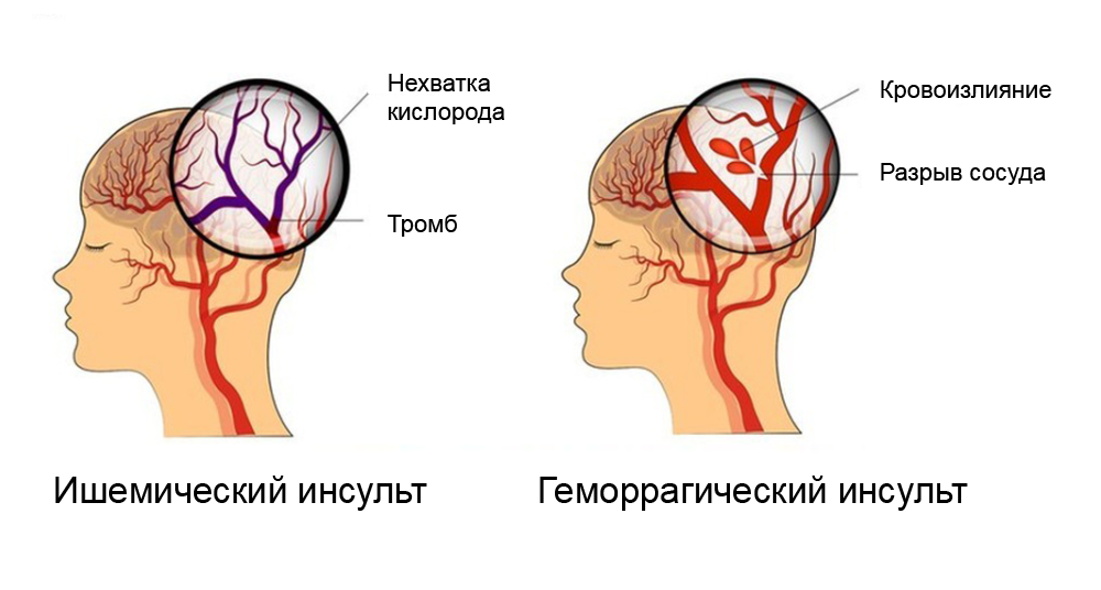 Ишемический инсульт встречается в шесть раз чаще, чем геморрагический. Источник: Op2Lysis