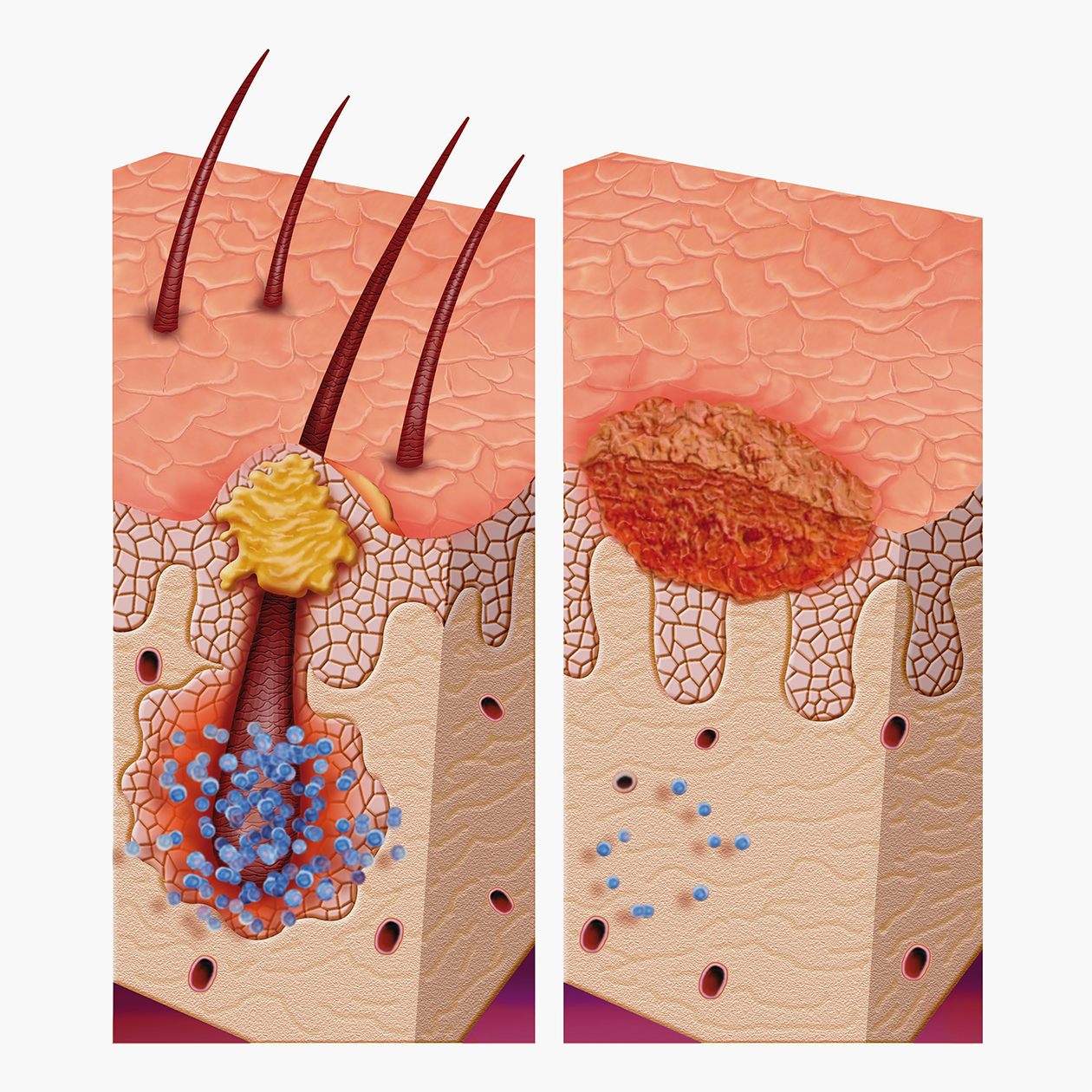 Так выглядит воспаленный фолликул. Источник: ilusmedical / Shutterstock