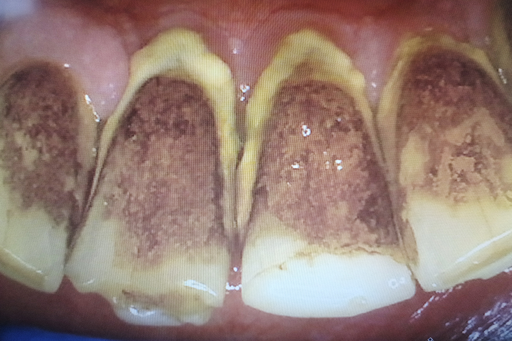Так выглядит пародонтит. Над и под деснами образовался камень, а на зубах — пигментированный налет