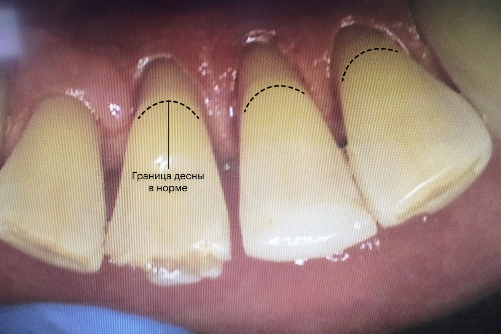 Так выглядят зубы после чистки. Камень отдавил десну, она опустилась и оголила пришеечные области