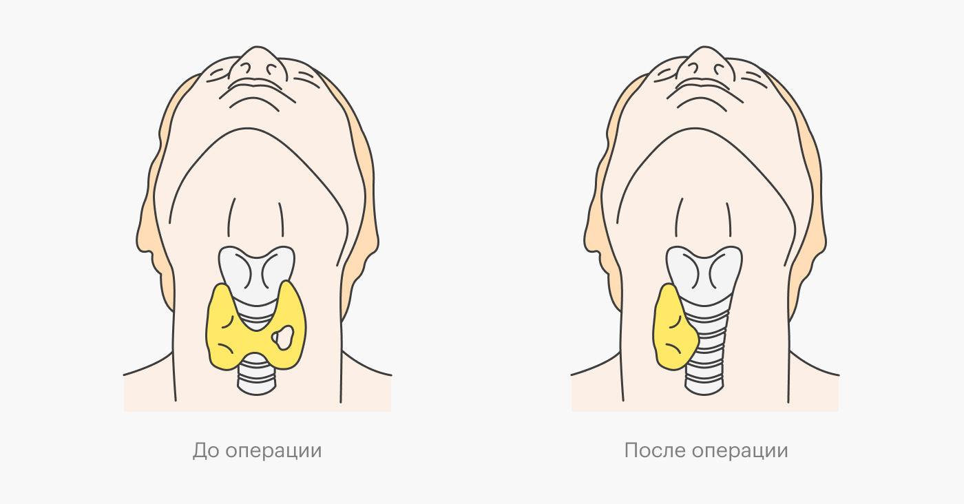 Врач может удалить не всю щитовидную железу, а только ее часть. Это зависит от размеров узла и его вида