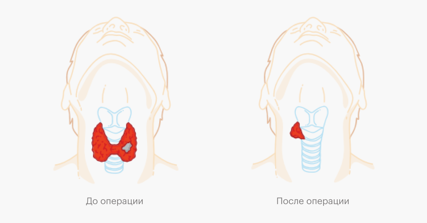 Врач может удалить не всю щитовидную железу, а только ее часть. Это зависит от размеров узла и его вида