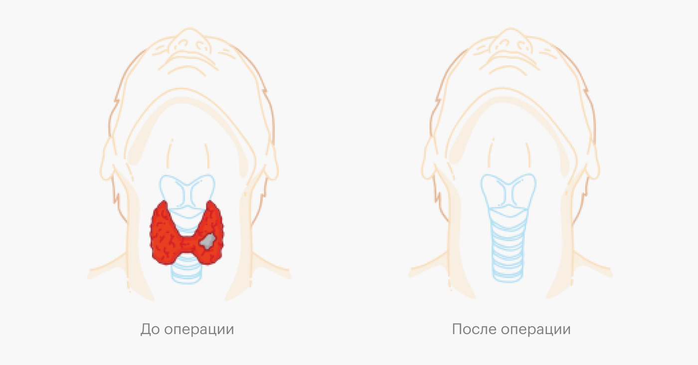 Врач может удалить не всю щитовидную железу, а только ее часть. Это зависит от размеров узла и его вида