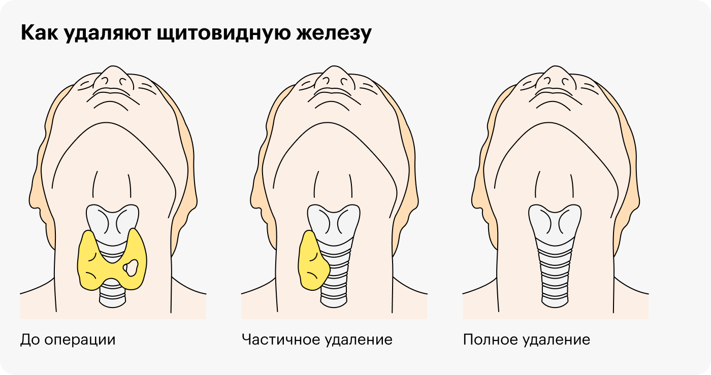 В зависимости от количества и размера узлов во время операции могут удалить как всю щитовидную железу, так и ее часть — тем не менее в полной мере выполнять прежние функции она уже не сможет