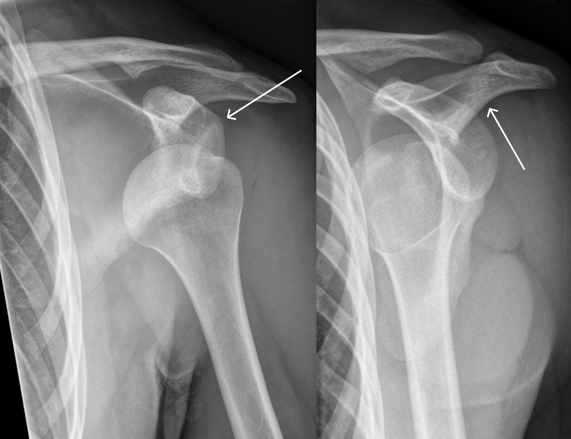 Вывих плеча на рентгенограмме: и на правом, и на левом снимке видно, что головка плечевой кости ушла со своего места в суставной впадине плечевого сустава. Стрелкой показано примерное расположение головки кости в норме. Источник: Hellerhoff / Wikimedia