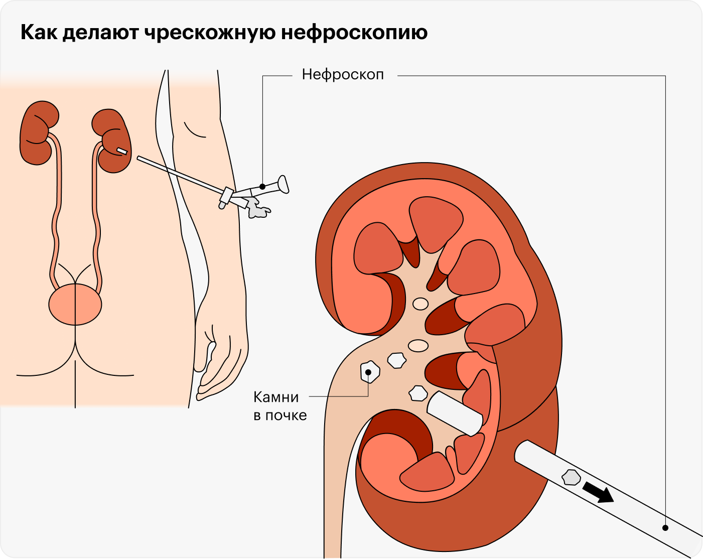 Чрескожная нефроскопия — удаление камня специальным прибором через прокол в коже спины