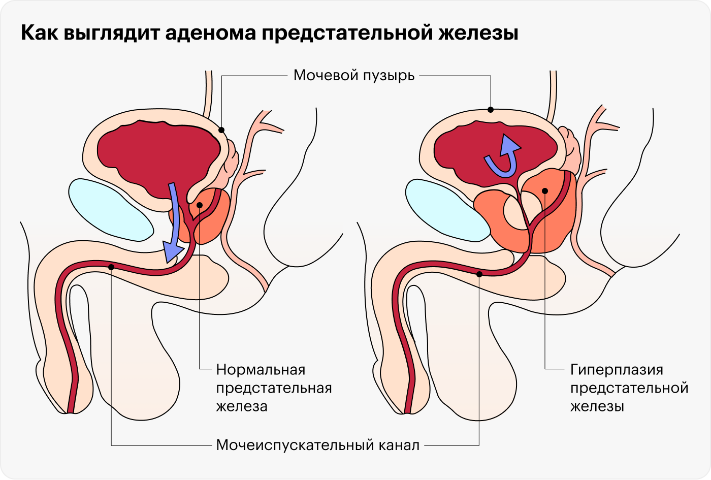 При аденоме предстательной железы она увеличивается и может пережать мочеиспускательный канал