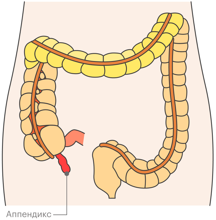 Аппендикс — участок толстой кишки. Когда он воспаляется, возникает аппендицит