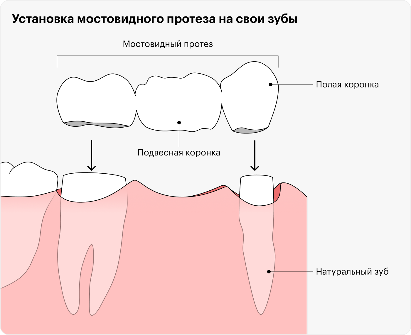 Так устанавливают зубные протезы