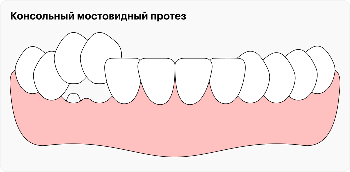 Консольный мостовидный протез крепится на один зуб. Этот зуб обтачивают, однако шинирования не происходит, ведь протез не соединяет два настоящих зуба друг с другом